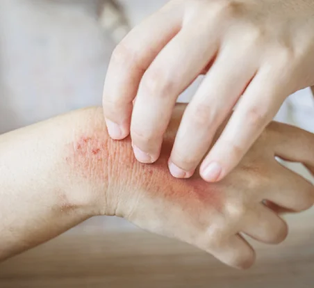 How Food Poisoning Impacts Your Complexion, and How to Bounce Back