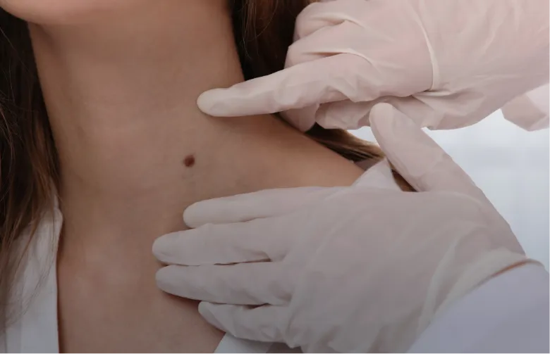 Mole Removal - What to Expect 2
