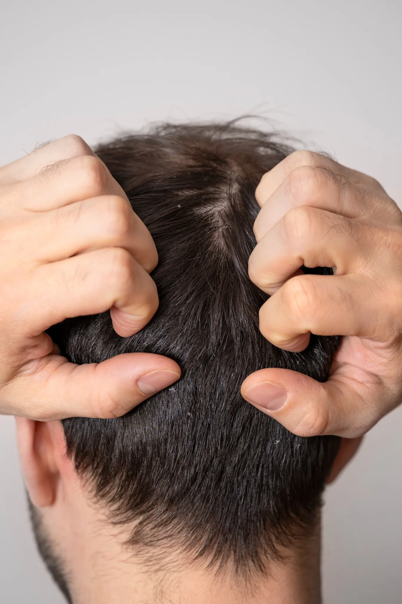 Man scratching his scalp. Have healthy scalp with the help from dermatologists