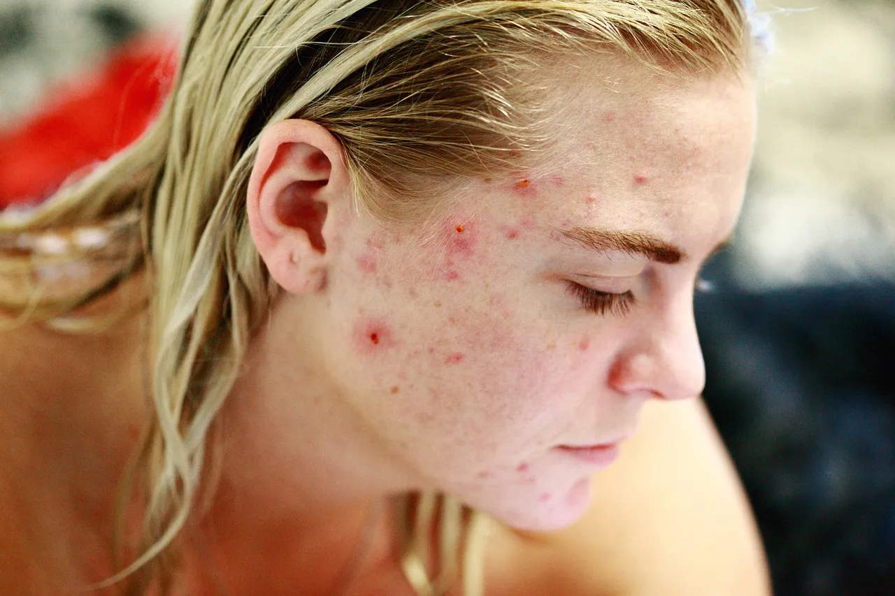 A woman with visible acne blemishes on her face, get your hormonal acne under control with Shine Dermatology