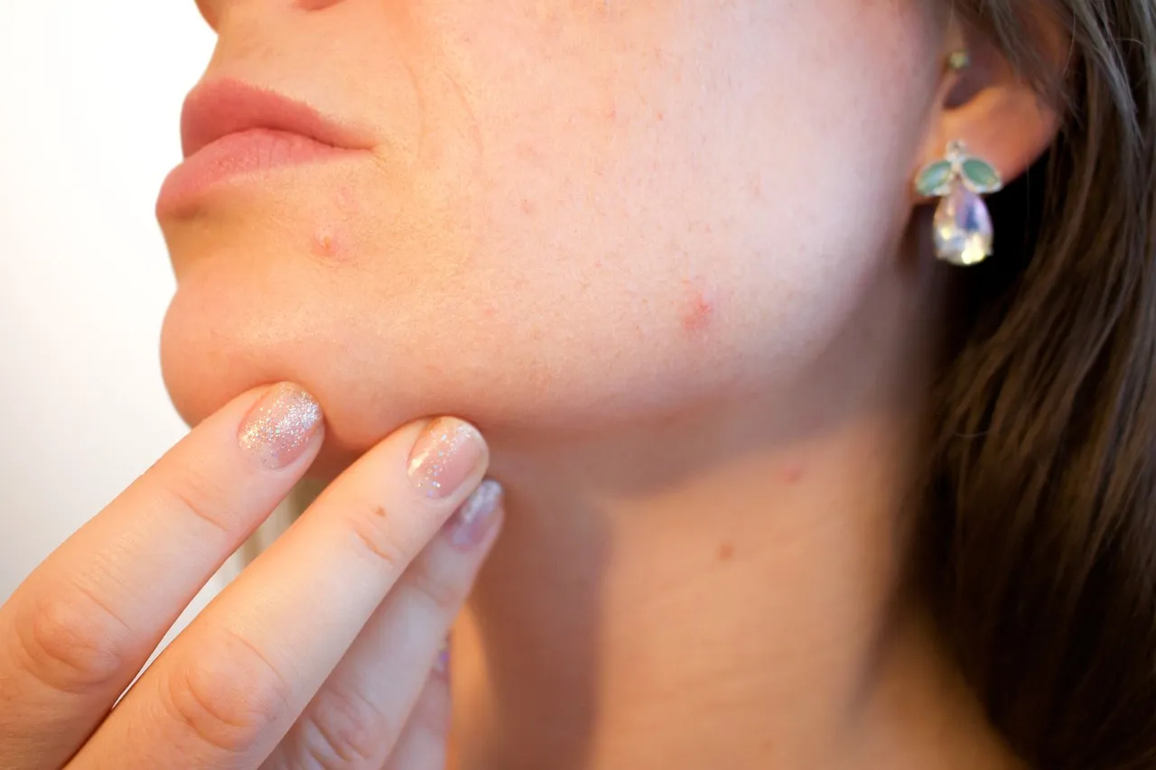 A woman with visible acne blemishes on her face