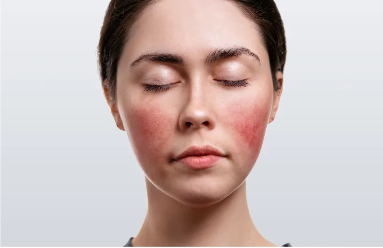 Rosacea